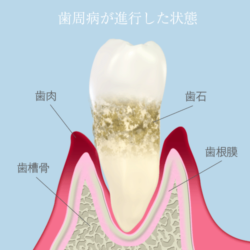 歯周病が進行した状態